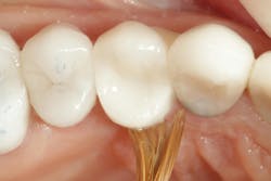 Figure 9: Remove excess on lingual with sable brush Figure 9: Remove excess on lingual with sable brush