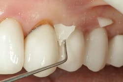 Figure 10: Remove Activa cement after gel set. Tack cure margins with curing light for 20 seconds. Figure 10: Remove Activa cement after gel set. Tack cure margins with curing light for 20 seconds.