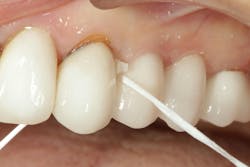 Figure 11: Floss contacts and light cure for 20 seconds. Figure 11: Floss contacts and light cure for 20 seconds.