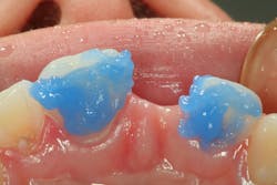 Figure 18: Etch preps Figure 18: Etch preps