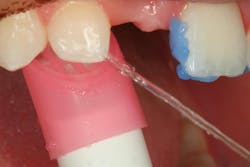 Figure 19: Remove etch Figure 19: Remove etch