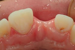 Figure 20: Etched preps Figure 20: Etched preps