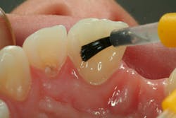 Figure 21: Placement of bonding adhesive Figure 21: Placement of bonding adhesive