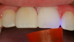 Figure 23: Place with Activa Cement and light cure Figure 23: Place with Activa Cement and light cure