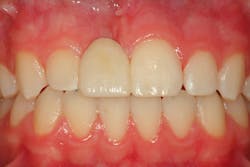 Figure 24: Postcementation Figure 24: Postcementation