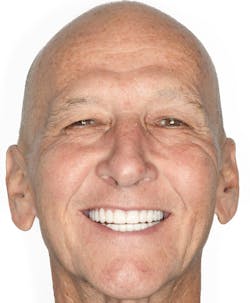 Figure 5: A patient wearing Ivotion dentures, showing the comfort and natural esthetics of this advanced material Figure 5: A patient wearing Ivotion dentures, showing the comfort and natural esthetics of this advanced material