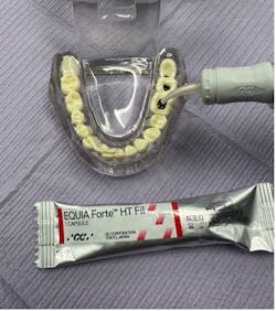 Figure 5: After caries arrest, apply glass ionomer cement Figure 5: After caries arrest, apply glass ionomer cement