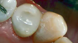 direct composite placement