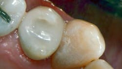 direct composite placement direct composite placement