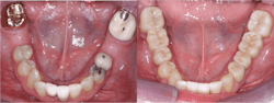 Figure 1: Two 3Y, full-strength zirconia fixed prostheses cemented with resin-modified glass ionomer (RelyX Luting, 3M) Figure 1: Two 3Y, full-strength zirconia fixed prostheses cemented with resin-modified glass ionomer (RelyX Luting, 3M)