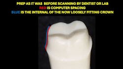 Figure 1: Computer spacing on crown tooth preparations causes several challenges. Because of significant spacing, some preps need to be cut deeper to accommodate the spacing. Figure 1: Computer spacing on crown tooth preparations causes several challenges. Because of significant spacing, some preps need to be cut deeper to accommodate the spacing.