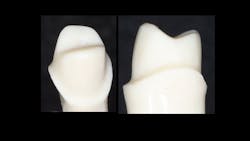 Figure 2: Because of the spacing labs are now placing on the entire surfaces of virtual preps, the intaglio surfaces of the crowns are smooth and the crowns seat easily. However, the margins are open the amount the lab tech spaced the die. This spacing causes the thickness of the crown material to be thinner and the prep to be respectively deeper. Use cariostatic cement-RMGI or conventional glass ionomer. Figure 2: Because of the spacing labs are now placing on the entire surfaces of virtual preps, the intaglio surfaces of the crowns are smooth and the crowns seat easily. However, the margins are open the amount the lab tech spaced the die. This spacing causes the thickness of the crown material to be thinner and the prep to be respectively deeper. Use cariostatic cement-RMGI or conventional glass ionomer.