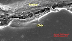 Figure 3: SEM photo of premium brand composite at three years in the mouth. It is an erroneous concept that composites “seal” the prep; they do not because of polymerization shrinkage. Figure 3: SEM photo of premium brand composite at three years in the mouth. It is an erroneous concept that composites “seal” the prep; they do not because of polymerization shrinkage.