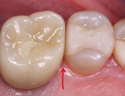 Figure 1: Over a lifetime, teeth naturally drift in a mesial direction. Implants do not move, and the mesial contact of especially posterior teeth often opens a few months after placing an implant. The food-catching open contact in this image occurred six months after we placed an implant and crown with an original tight mesial contact on the molar, demonstrating mesial movement of the composite-restored premolar from another practice. Figure 1: Over a lifetime, teeth naturally drift in a mesial direction. Implants do not move, and the mesial contact of especially posterior teeth often opens a few months after placing an implant. The food-catching open contact in this image occurred six months after we placed an implant and crown with an original tight mesial contact on the molar, demonstrating mesial movement of the composite-restored premolar from another practice.