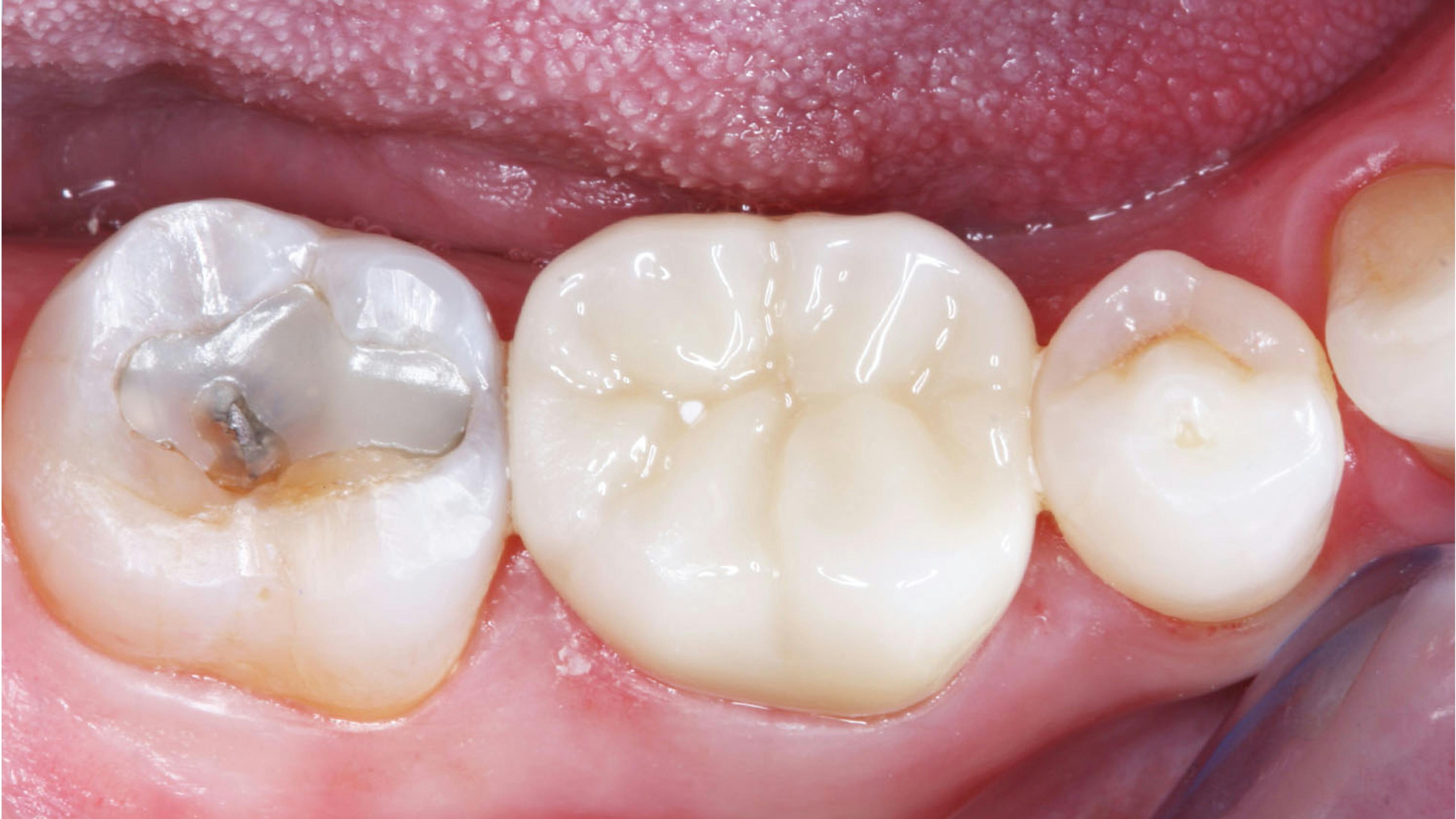 Figure 2: Consider the potential occlusal significance of this clinical situation: a worn class I composite needing replacement on the second molar, a rock-hard, nonwearing zirconia crown on the first molar, and a natural premolar tooth.
