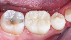 Figure 2: Consider the potential occlusal significance of this clinical situation: a worn class I composite needing replacement on the second molar, a rock-hard, nonwearing zirconia crown on the first molar, and a natural premolar tooth. Figure 2: Consider the potential occlusal significance of this clinical situation: a worn class I composite needing replacement on the second molar, a rock-hard, nonwearing zirconia crown on the first molar, and a natural premolar tooth.