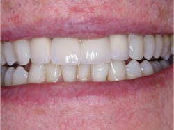 Figure 3: Will those four beautiful, just-cemented ceramic crowns destroy the incisal guidance for this patient or not? Some materials won’t (for example, unstained, unglazed lithium disilicate), and some will (for example, some brands of 4Y, 5Y zirconia crowns). Figure 3: Will those four beautiful, just-cemented ceramic crowns destroy the incisal guidance for this patient or not? Some materials won’t (for example, unstained, unglazed lithium disilicate), and some will (for example, some brands of 4Y, 5Y zirconia crowns).
