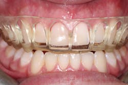 cosmetic dentistry crown lengthening cosmetic dentistry crown lengthening