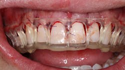 cosmetic dentistry crown lengthening cosmetic dentistry crown lengthening