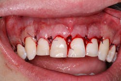 cosmetic dentistry crown lengthening cosmetic dentistry crown lengthening