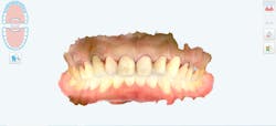 cosmetic dentistry crown lengthening cosmetic dentistry crown lengthening