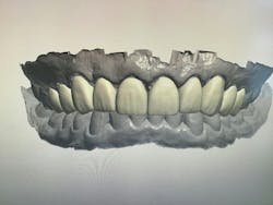 cosmetic dentistry crown lengthening cosmetic dentistry crown lengthening