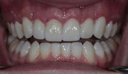 cosmetic dentistry crown lengthening cosmetic dentistry crown lengthening