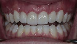 cosmetic dentistry crown lengthening cosmetic dentistry crown lengthening