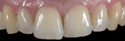 Figure 1: Pre-op situation: Misaligned central incisors. Figure 1: Pre-op situation: Misaligned central incisors.