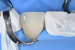 Figure 5: Verifying the fit of the veneer after rubber dam placement. Figure 5: Verifying the fit of the veneer after rubber dam placement.