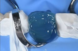 Figure 6: Etching the tooth surface with phosphoric acid: allow to react for 30 seconds, rinse with water for 40 seconds. Figure 6: Etching the tooth surface with phosphoric acid: allow to react for 30 seconds, rinse with water for 40 seconds.