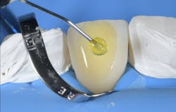 Figure 7: Applying the adhesive (Adhese Universal) using the VivaPen. Figure 7: Applying the adhesive (Adhese Universal) using the VivaPen.