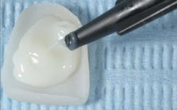 Figure 8: Comfortable handling and targeted application of Variolink Esthetic LC. Figure 8: Comfortable handling and targeted application of Variolink Esthetic LC.