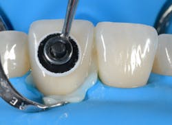 Figure 10: … and flowable consistency when placing the veneer on the tooth. Figure 10: … and flowable consistency when placing the veneer on the tooth.