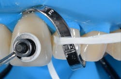 Figure 11: Removal of excess material immediately after placement and two-second tack cure. Figure 11: Removal of excess material immediately after placement and two-second tack cure.