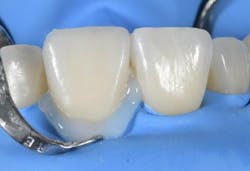 Figure 12: Covering the cementation joint with glycerine gel. Figure 12: Covering the cementation joint with glycerine gel.