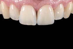 Figure 14: Ten days after the placement of the veneer: a natural-looking beautiful result. Figure 14: Ten days after the placement of the veneer: a natural-looking beautiful result.