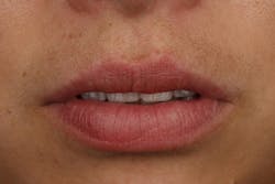 Figure 1b: ... or close-up allows us to determine proper incisal edge position. Figure 1b: ... or close-up allows us to determine proper incisal edge position.