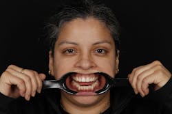 Figure 3: Full-face with retractors to visualize the maxillary arch is helpful when the patient has limited tooth display, even in a full smile. Figure 3: Full-face with retractors to visualize the maxillary arch is helpful when the patient has limited tooth display, even in a full smile.