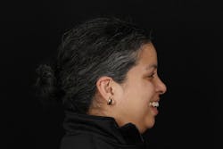 Figure 4: Full-face profile smile photo is to assess maxillary plane and anterior-posterior relationship. Figure 4: Full-face profile smile photo is to assess maxillary plane and anterior-posterior relationship.