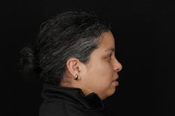 Figure 5: Full-face profile repose photo for facial profile analysis Figure 5: Full-face profile repose photo for facial profile analysis