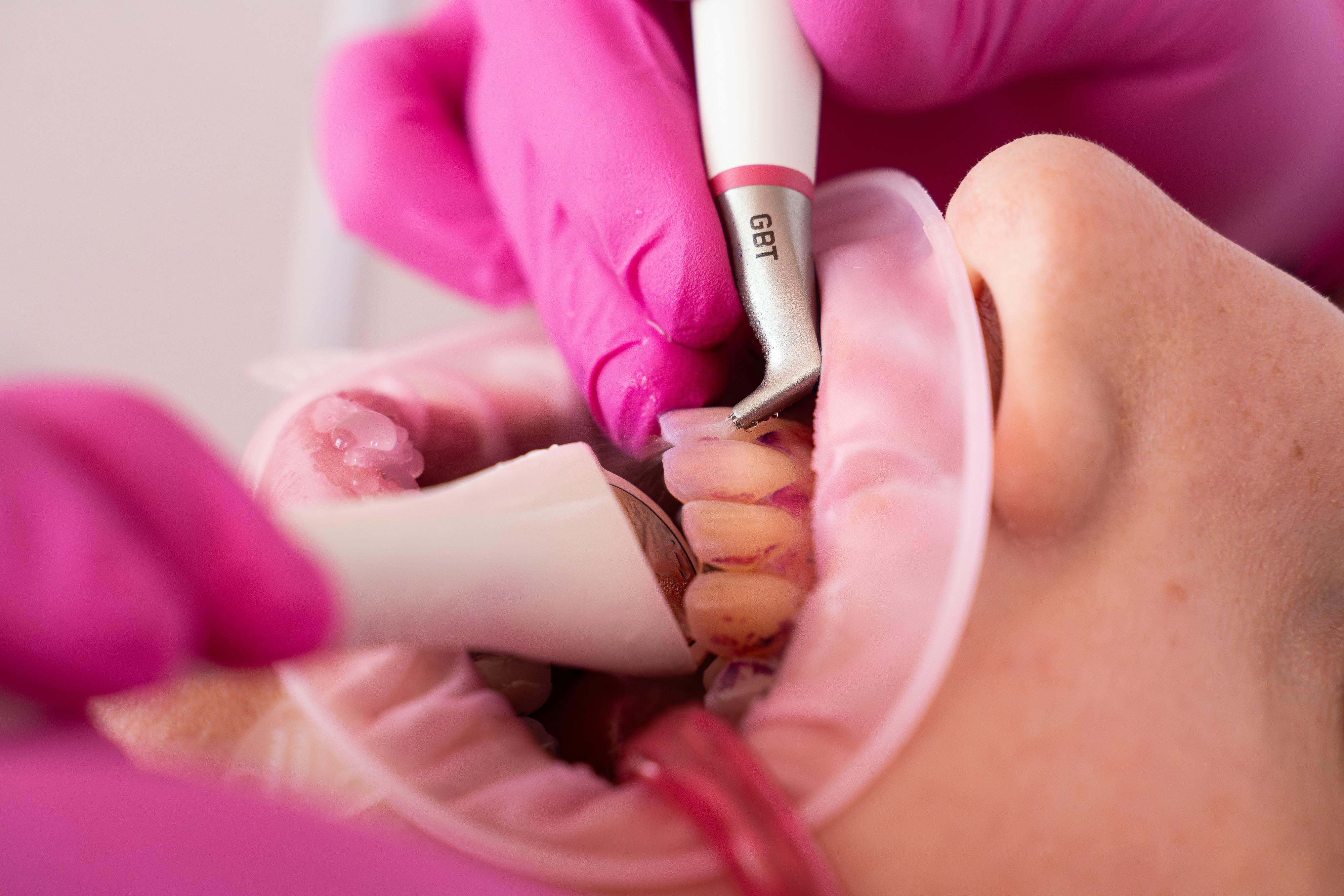 Figure 2: State-of-the-art prevention utilizes AIR-FLOWING&circledR;: this effective yet particularly gentle method is suitable for biofilm management of all oral tissues as well as of implants and restorations.