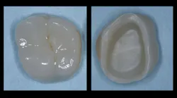 zirconia