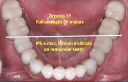zirconia zirconia
