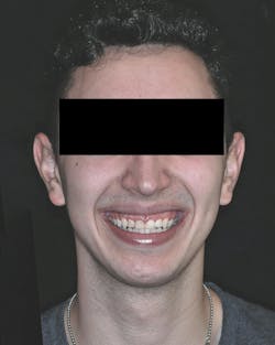 cosmetic dentistry crown lengthening cosmetic dentistry crown lengthening