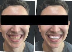 cosmetic dentistry crown lengthening cosmetic dentistry crown lengthening
