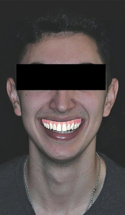 cosmetic dentistry crown lengthening cosmetic dentistry crown lengthening