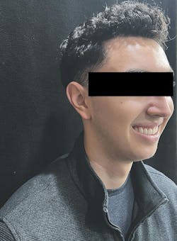 cosmetic dentistry crown lengthening cosmetic dentistry crown lengthening