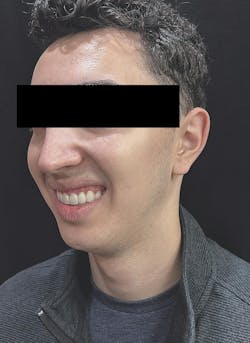 cosmetic dentistry crown lengthening cosmetic dentistry crown lengthening