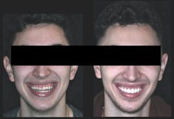 cosmetic dentistry crown lengthening cosmetic dentistry crown lengthening